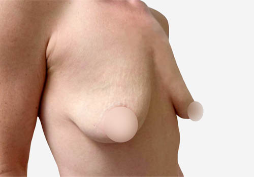 Breast Lift