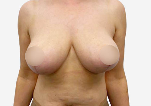 Breast Lift