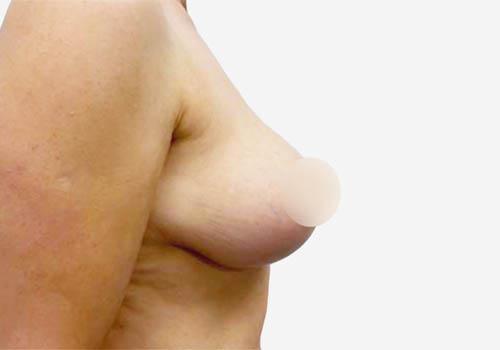 Breast Lift