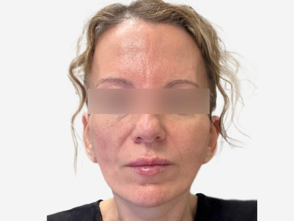 Face & Neck Lift