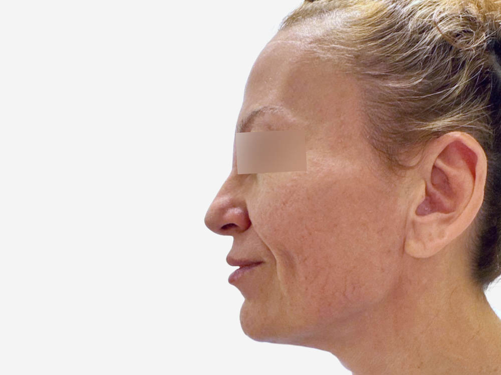 Face & Neck Lift