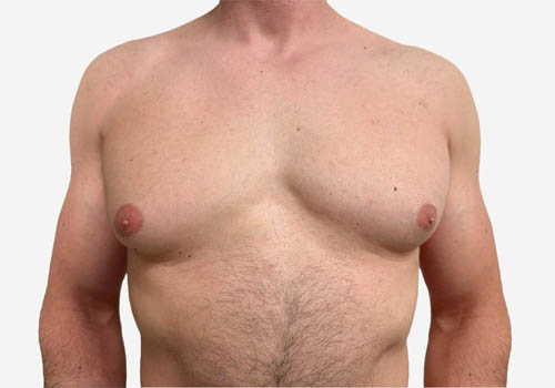 Male Breast Reduction