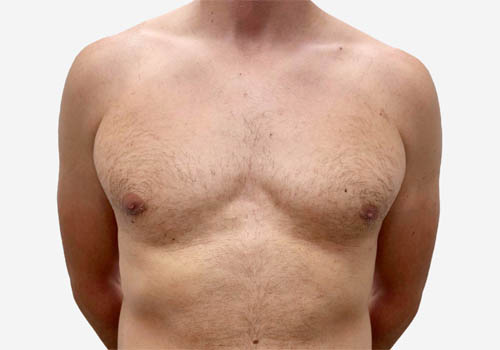 Male Breast Reduction