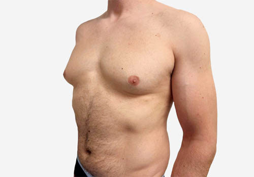 Male Breast Reduction