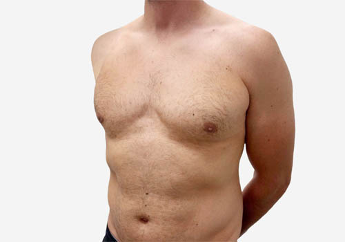 Male Breast Reduction