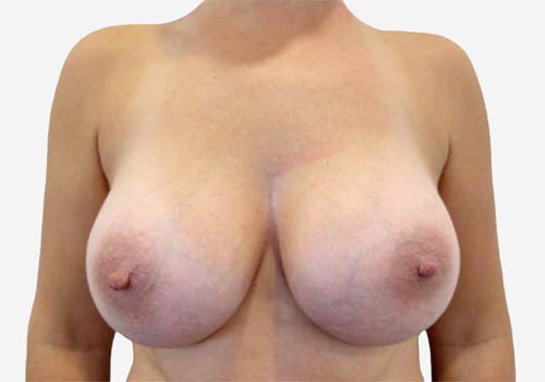 Breast Augmentation