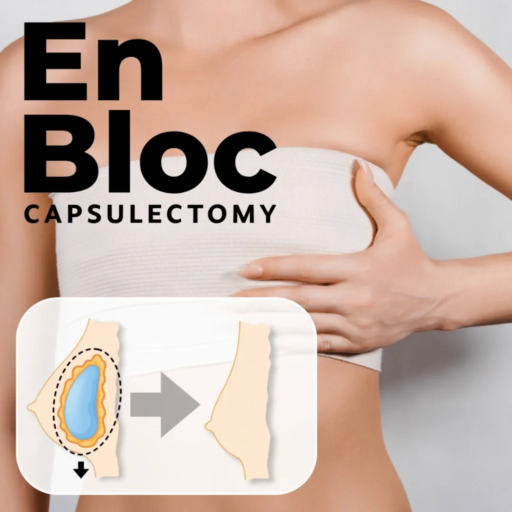 Why More and More Patients Are Interested in En Bloc Capsulectomy