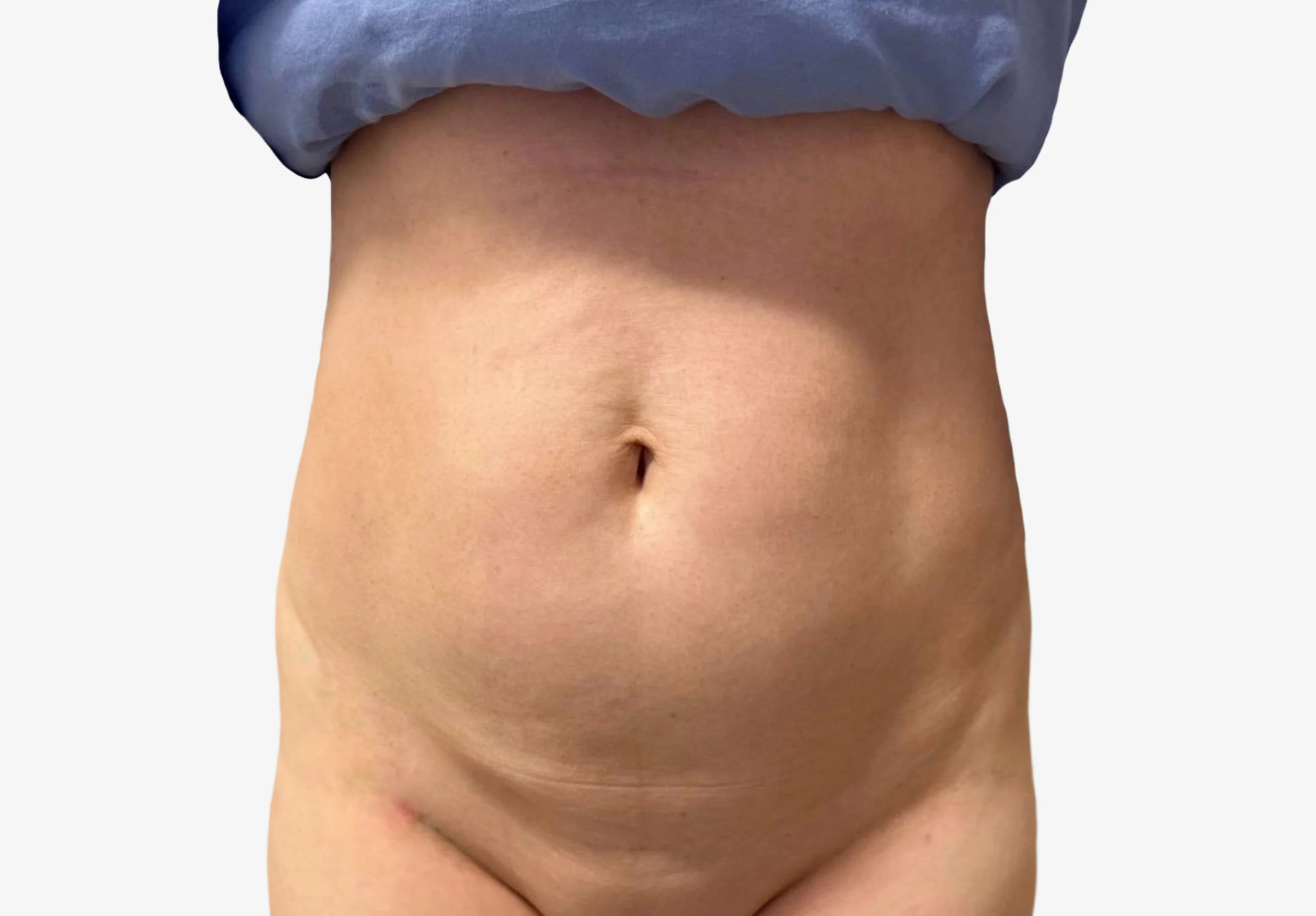 Tummy Tuck