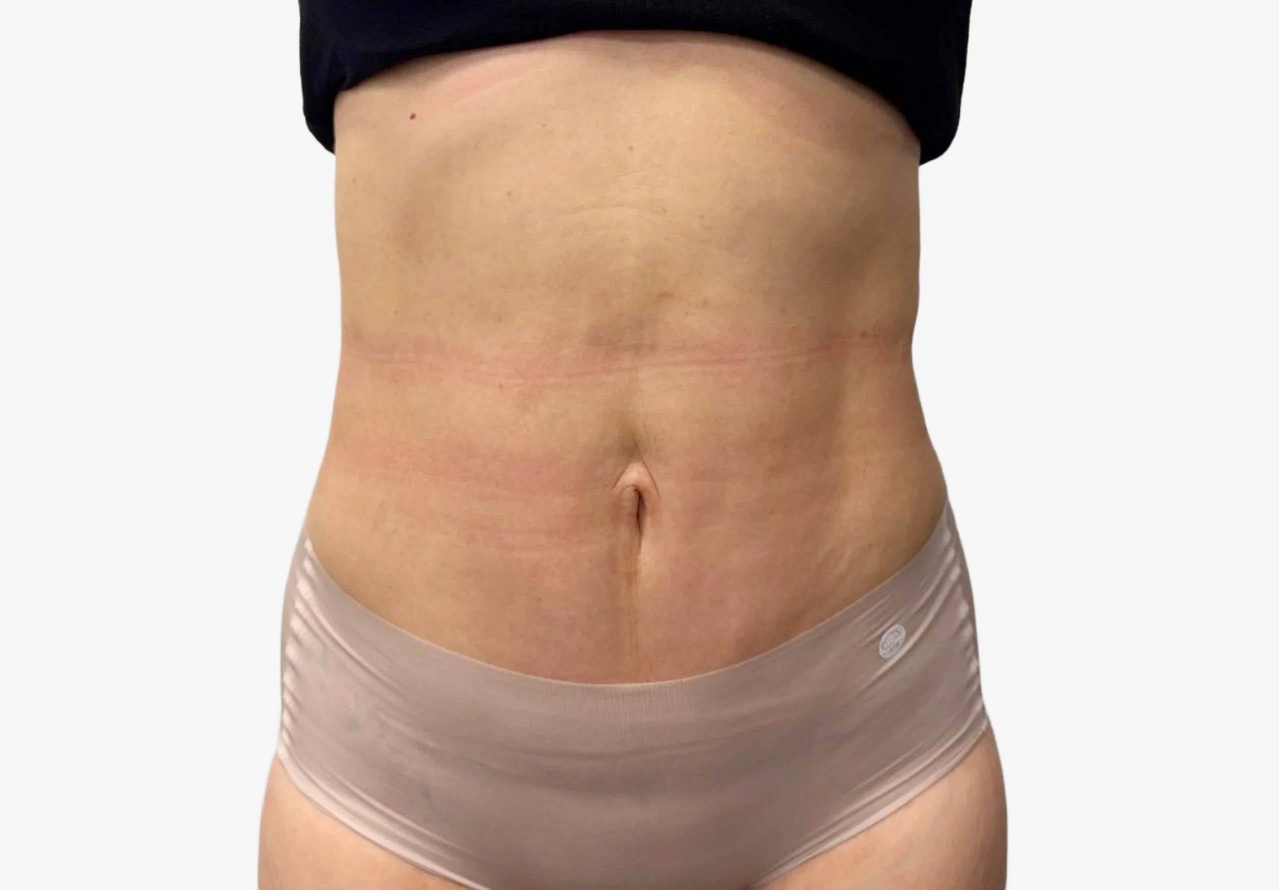 Tummy Tuck
