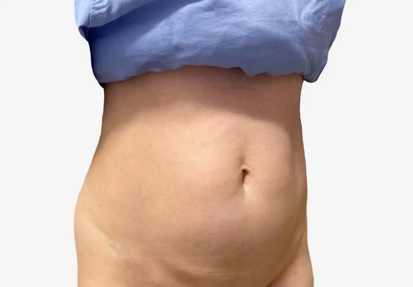 Tummy Tuck