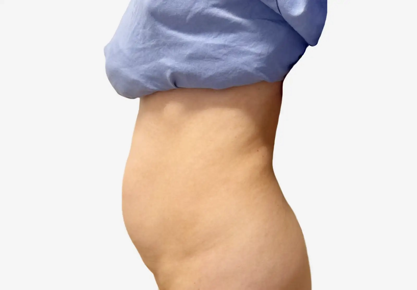 Tummy Tuck