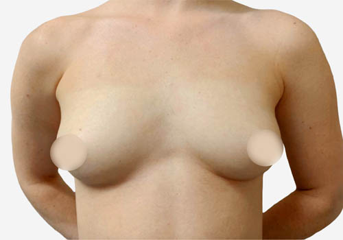 Breast Augmentation