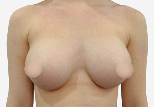 Breast Augmentation