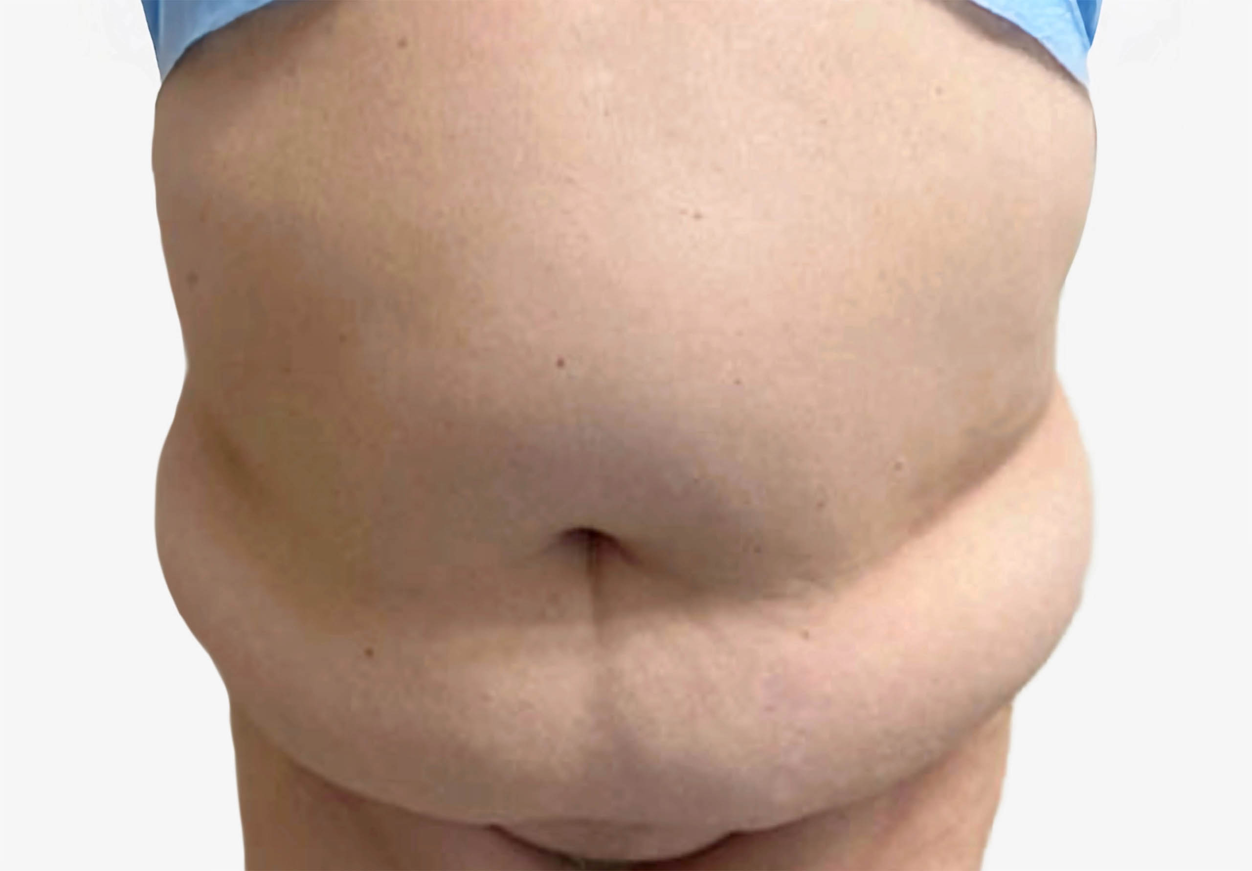 Tummy Tuck