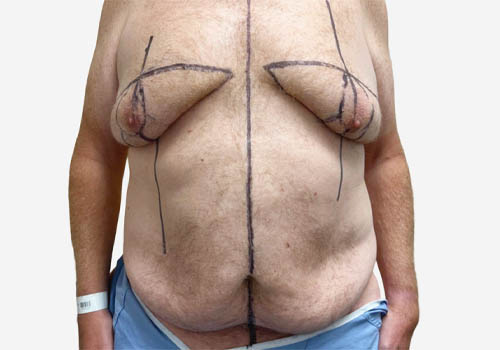 Tummy Tuck