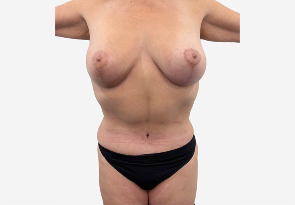 Tummy Tuck